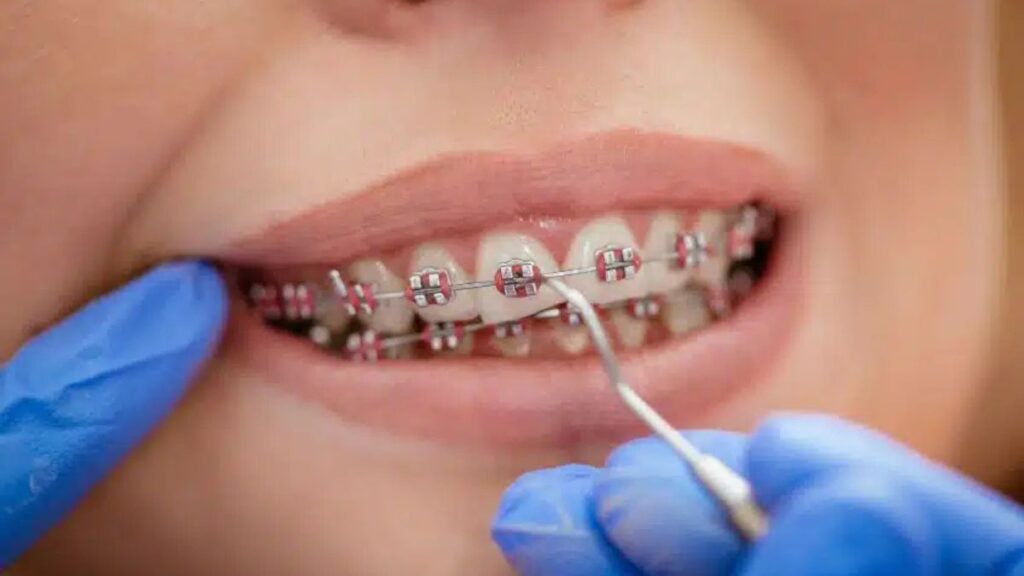 Orthodontic Treatment