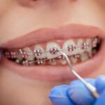 How Braces and Orthodontic Treatment Can Transform Smiles